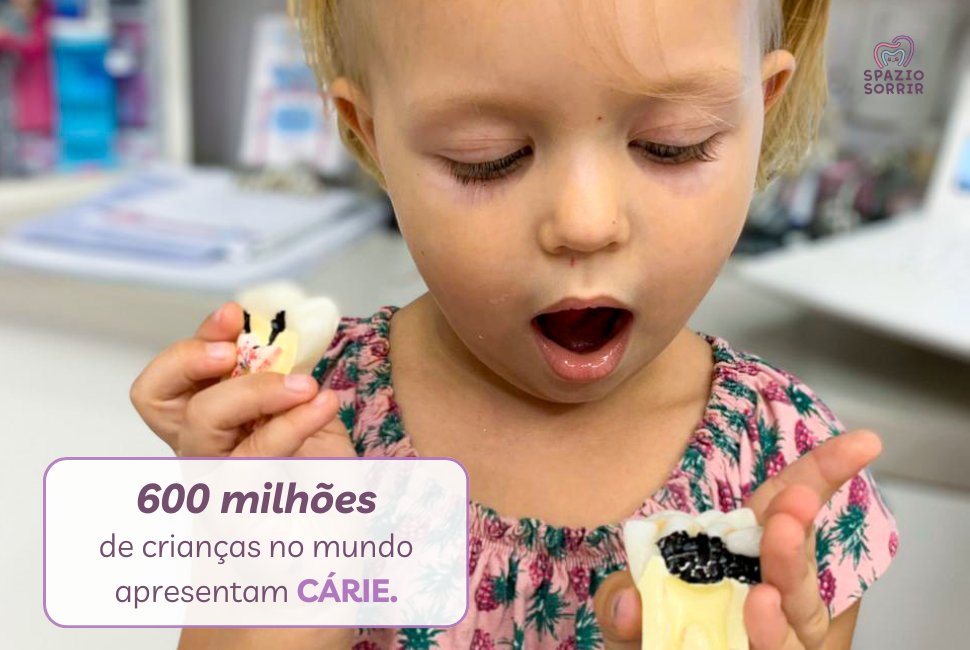 Postagem 600 milhões de crianças no mundo apresentam CÁRIE.