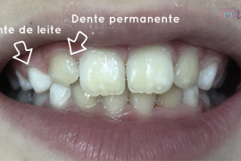 Postagem OS DENTES PERMANENTES ESTÃO NASCENDO AMARELOS. POR QUE?